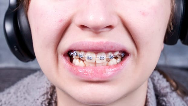 Happy smiling teenage girl with dental braces and face acne. Orthodontic treatment