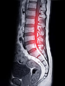 MRI L-S spine or lumbar spine Sagittall T1W view  for diagnosis spinal cord compression.