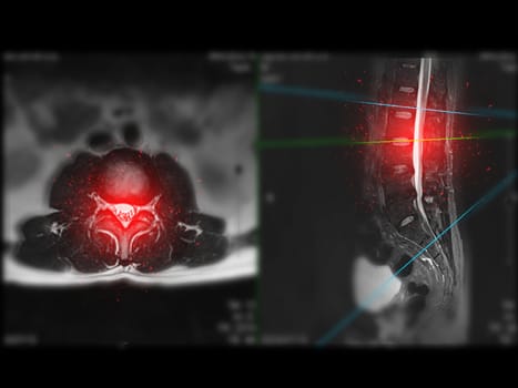 MRI L-S spine or lumbar spine Axial T2W view with sagittal plane for diagnosis spinal cord compression.