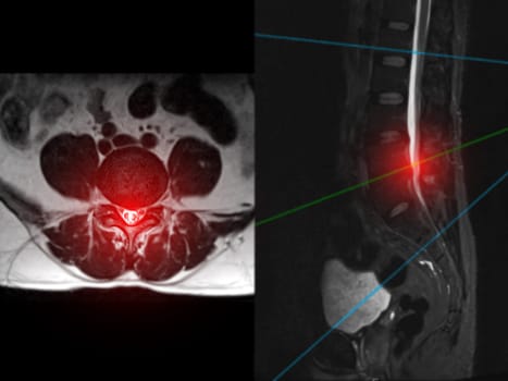 MRI L-S spine or lumbar spine Axial T2W view with sagittal plane for diagnosis spinal cord compression.