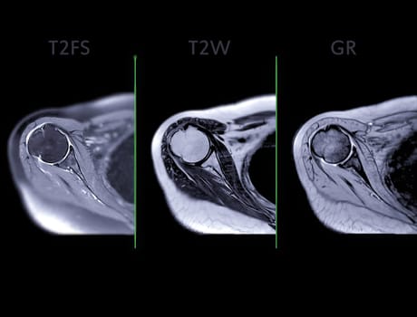 Magnetic Resonance Imaging or MRI of Shoulder Joint Axial T2FS,T2W and mFFE for diagnostic shoulder pain.