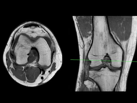 Magnetic resonance imaging or MRI of  knee joint Axial T2  and Coronal view for detect tear or sprain of the anterior cruciate  ligament (ACL)
