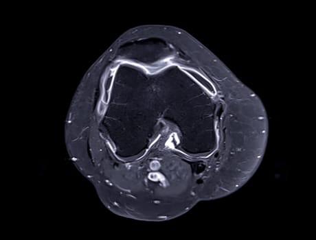 Magnetic resonance imaging or MRI of  knee joint Axial  view T2 FS with Gadolinium for detect tear or sprain of the anterior cruciate  ligament (ACL)
