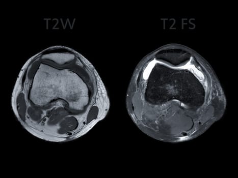 Magnetic resonance imaging or MRI of  knee joint Axial view T2 and T2 FS  for detect tear or sprain of the anterior cruciate  ligament (ACL)