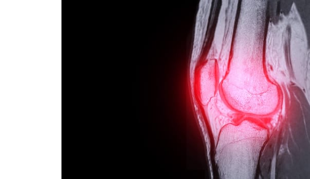 Magnetic resonance imaging or MRI of  knee joint  sagittal  PDW for detect tear or sprain of the anterior cruciate  ligament (ACL)