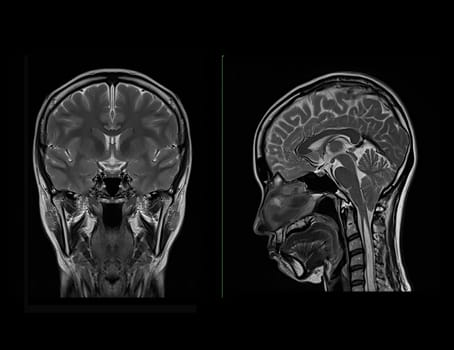 MRI  brain scan  Compare Coronal and sagittal plane for detect  Brain  diseases sush as stroke disease, Brain tumors and Infections.