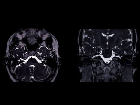 MRI Brain scan  with  the internal auditory canal (IAC) axial  and Coronal view. 