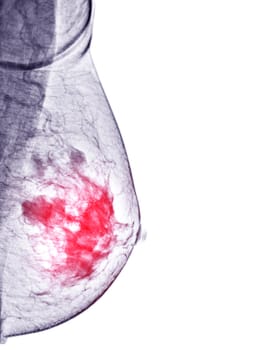  X-ray Digital Mammogram right side  MLO view . mammography or breast scan for Breast cancer BI-RADS 5; Highly suggestive of malignancy .