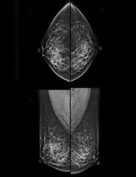  X-ray Digital Mammogram of both CC and MLO view . mammography or breast scan for Breast cancer..