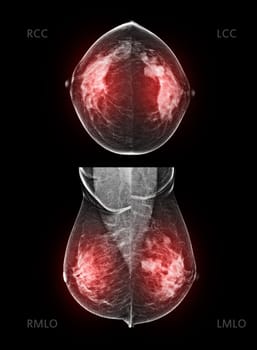  X-ray Digital Mammogram both side CC and MLO view . mammography or breast scan for Breast cancer BI-RADS 5; Highly suggestive of malignancy .