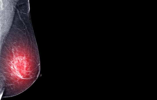  X-ray Digital Mammogram of Right  side  MLO view . mammography or breast scan for Breast cancer  showing BI-RADS CATEGORY 2  Benign tumor.