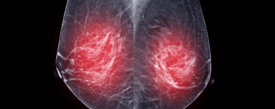 X-ray Digital Mammogram of Right  side  MLO view . mammography or breast scan for Breast cancer  showing BI-RADS CATEGORY 2  Benign tumor.