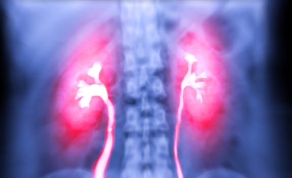  Intravenous pyelogram or I.V.P is an X-ray exam of urinary tract after injection contrast media agent  .