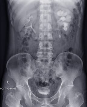  Intravenous pyelogram or I.V.P is an X-ray exam of urinary tract after injection contrast media agent  .