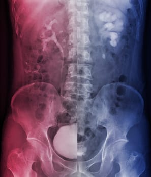  Intravenous pyelogram or I.V.P is an X-ray exam of urinary tract after injection contrast media agent  .