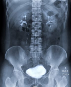  Intravenous pyelogram or I.V.P is an X-ray exam of urinary tract after injection contrast media agent  .