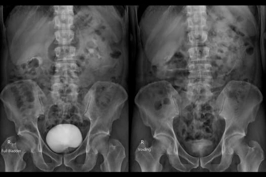  Intravenous pyelogram or I.V.P is an X-ray exam of urinary tract after injection contrast media agent  .