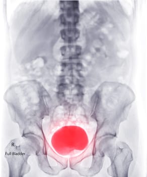  Intravenous pyelogram or I.V.P is an X-ray exam of urinary tract after injection contrast media agent  .