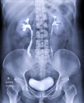  Intravenous pyelogram or I.V.P is an X-ray exam of urinary tract after injection contrast media agent  .