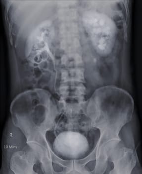  Intravenous pyelogram or I.V.P is an X-ray exam of urinary tract after injection contrast media agent  .