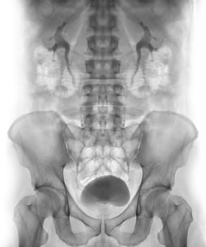  Intravenous pyelogram or I.V.P is an X-ray exam of urinary tract after injection contrast media agent  .