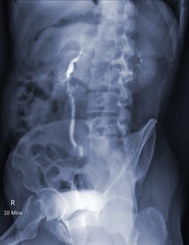  Intravenous pyelogram or I.V.P is an X-ray exam of urinary tract after injection contrast media agent  .