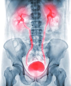  Intravenous pyelogram or I.V.P is an X-ray exam of urinary tract after injection contrast media agent  .