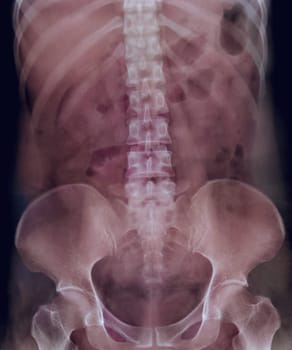  Intravenous pyelogram or I.V.P is an X-ray exam of urinary tract after injection contrast media agent  .