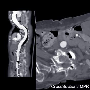 CTA whole aorta MPR Curve.