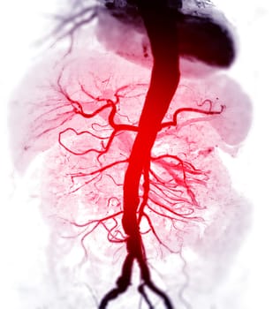 CTA whole aorta 3D rendering.