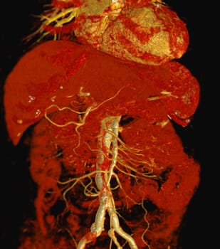 CTA whole aorta 3D rendering.