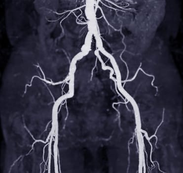 CTA femoral artery run off image of femoral artery for diagnostic  Acute or Chronic Peripheral Arterial Disease.