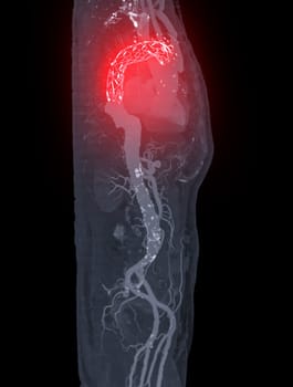 CTA whole aorta with thoracic aorta stent graft 3D rendering image in case  abdominal aortic aneurysms.