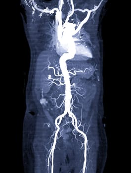 CTA whole aorta 3D rendering.