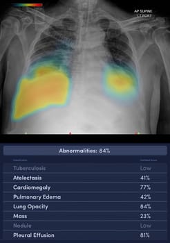 Chest x-ray image with (AI : Artificial Intelligence) report.