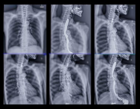 Barium Swallow study test diagnose Barrett's GI tract exam GERD ulcers series difficulty pharynx procedure UGI throat bowel therapy by fluoroscopy devices.