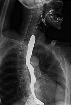 Barium Swallow study test diagnose Barrett's GI tract exam GERD ulcers series difficulty pharynx procedure UGI throat bowel therapy by fluoroscopy devices.