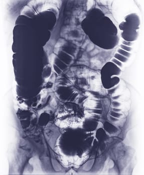 Barium enema study image or x-ray image of large intestine .