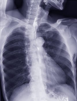 Barium Swallow study test diagnose Barrett's GI tract exam GERD ulcers series difficulty pharynx procedure UGI throat bowel therapy by fluoroscopy devices.