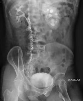  Intravenous pyelogram or I.V.P is an X-ray exam of urinary tract after injection contrast media agent  .