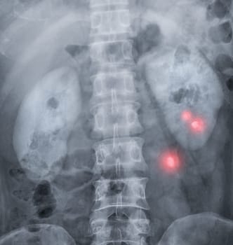  Intravenous pyelogram or I.V.P is an X-ray exam of urinary tract after injection contrast media agent  .