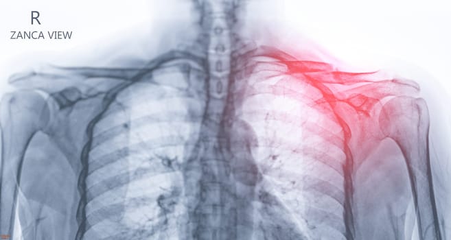 X-ray of Clavicle bone  showing fracture of  Clavicle bone  .