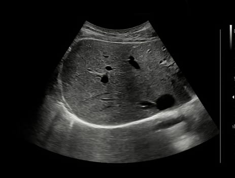 Ultrasound upper abdomen for diagnosis abdominal pain.