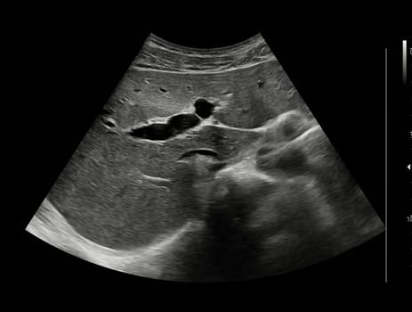 Ultrasound upper abdomen for diagnosis abdominal pain.