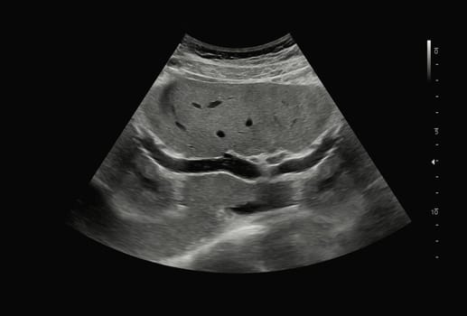 Ultrasound upper abdomen for diagnosis abdominal pain.