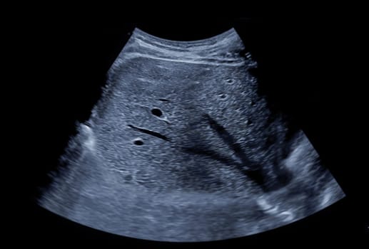 Ultrasound upper abdomen for diagnosis abdominal pain.