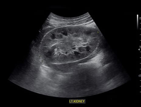 Ultrasound of Kidney  or KUB  for  screening  renal stone disease or Urolithiasis.