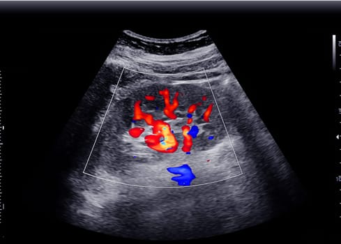 Ultrasound of Kidney  or KUB  for  screening  renal stone disease.