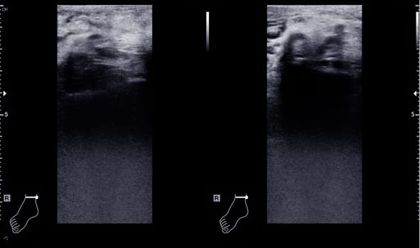 Color Doppler ultrasound determination in deep vein thrombosis patients for finding  deep vein thrombosis of lower extremity.