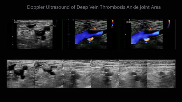 Color Doppler ultrasound determination in deep vein thrombosis patients for finding  deep vein thrombosis of lower extremity.